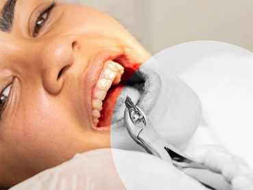 Widom teeth Removal Surgery