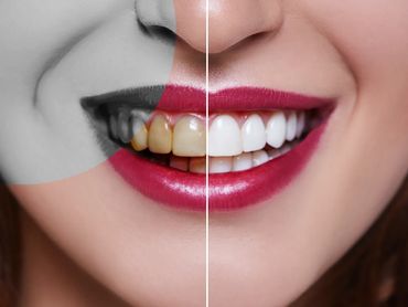 Whitening Before and after United dental Clinic North York