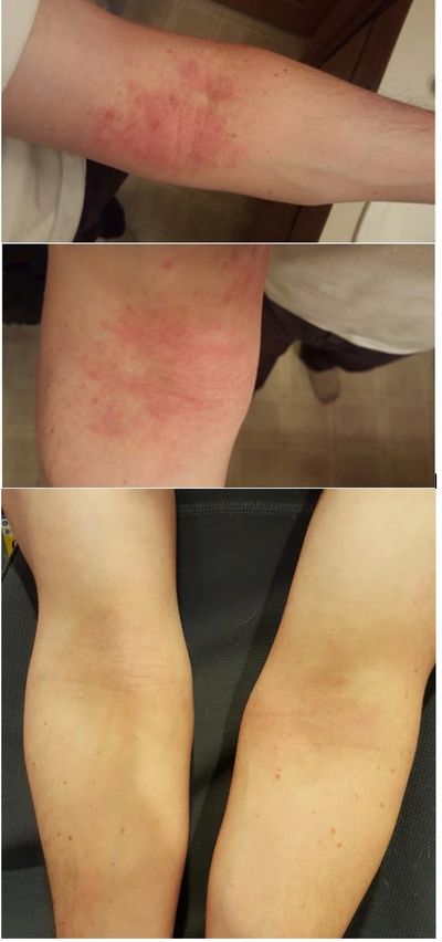 Chinese herbal medicine treatment for eczema