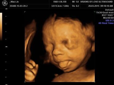 3D/4D ultrasound