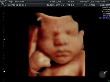 HD ultrasound
