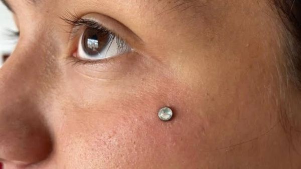 Close-up of facial skin with a dermal cheek piercing.