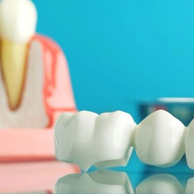 Les couronnes dentaires et les ponts dentaires sont des options pour restaurer les dents endommagées