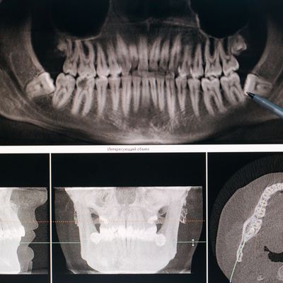 Extraction de dents simple et complexe