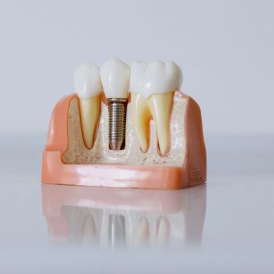 L'implant dentaire est une manière sûre de remplacer la dent naturelle. 