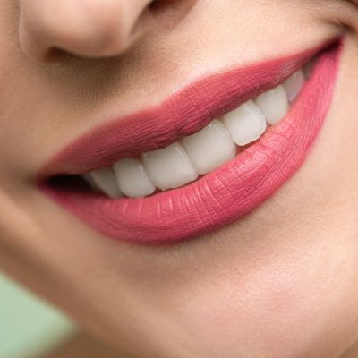 Un sourire plus blanc grâce au blanchiment dentaire