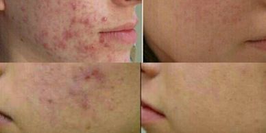 O excesso de oleosidade da pele estimula o aparecimento da acne, deixando a feia e afeta a auto-esti
