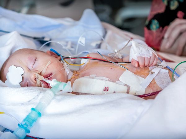 Newborn baby in intensive care with medical tubes and monitors.