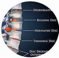 Disc conditions and chiropractic