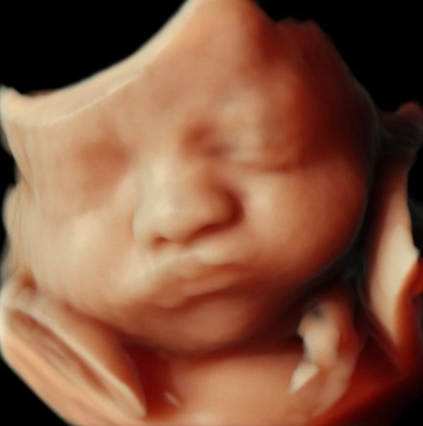 3D ultrasound image of a fetus.