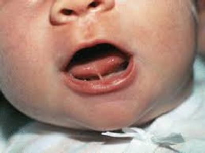 Baby with a Tongue-Tie (Frenulotomy)