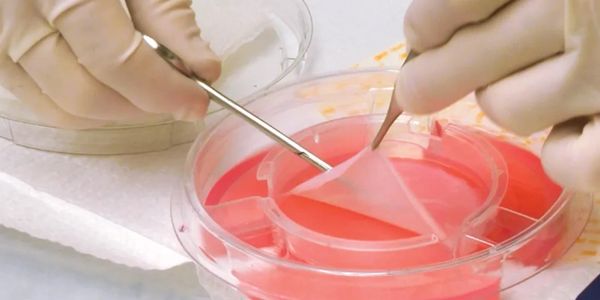 A wound care provider prepares an advanced wound care graft for placement.