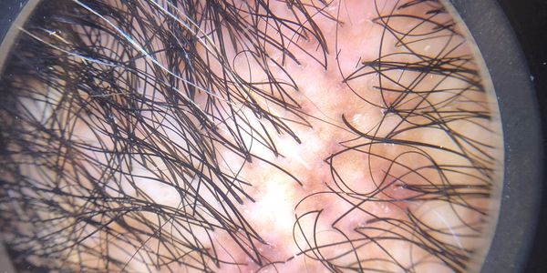 Magnified image of scalp.