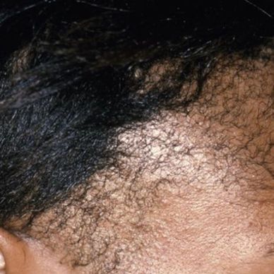 Image of Traction Alopecia
