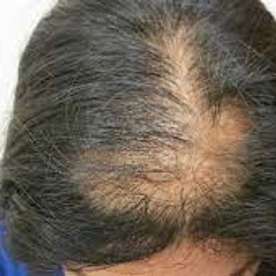 Image of Diffuse Hair Loss