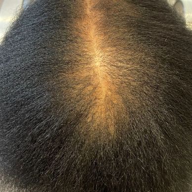 Image of Androgenetic Alopecia