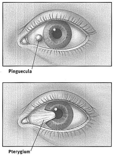 Pterygium cause redness and irritation in eyes.