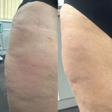 Fat dissolving injections on small pockets of fat for client in www.skinsolutionsacltd.co.uk