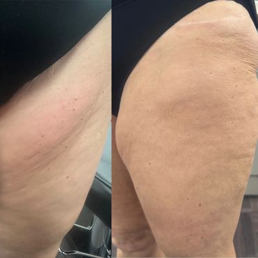 Fat dissolving injections on small pockets of fat for client in wFat dissolving injections on small