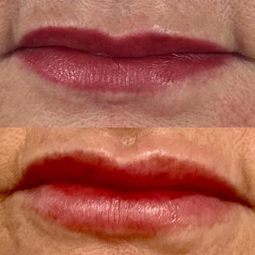 Lip filler before and after