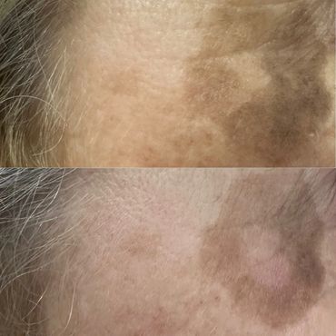 Reduction in pigment colour after just one IPL session