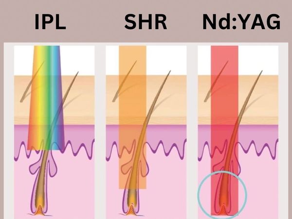 IPL, shr and nd:yag diagram showing different treatment actions of the 3 lasers used in hair removal