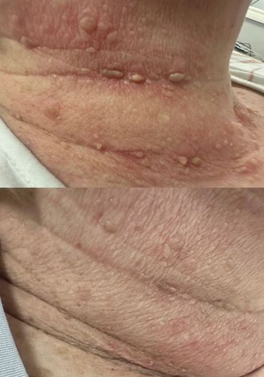 Cryotherapy before and after