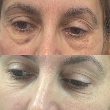Eyes pre and post lumi eyes treatment