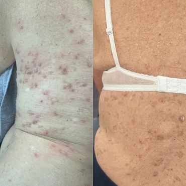 before and after seborrheic keratosis removal