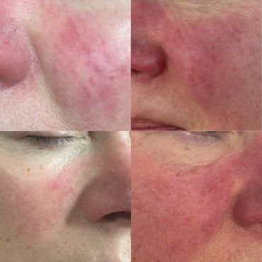 Electrocoagulation spider and thread vein removal before and after
