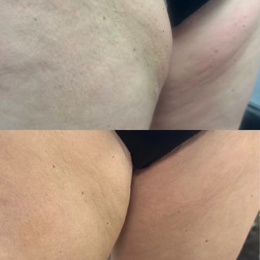 Fat dissolving injections on small pockets of fat for client in wFat dissolving injections on small