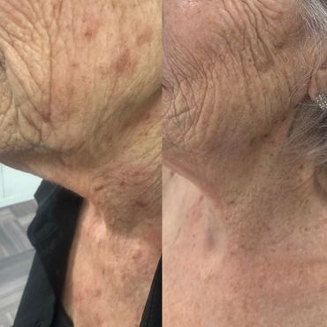 Cryotherapy before and after