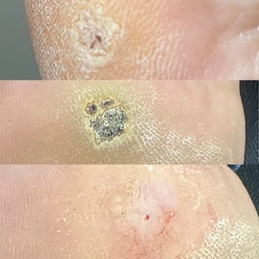 before, during and after cryotherapy verruca removal