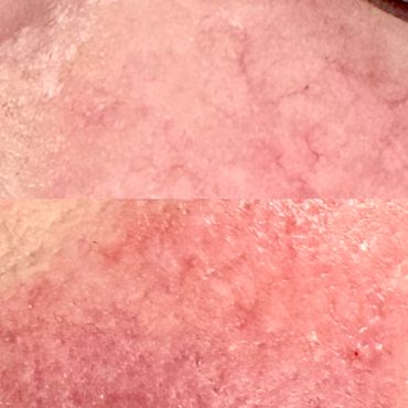 Electrocoagulation spider and thread vein removal before and after