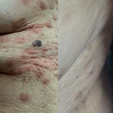 Cryotherapy before and after