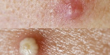 pustules and papules on skin