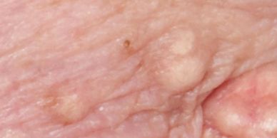 spots on skin