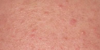 whiteheads on skin