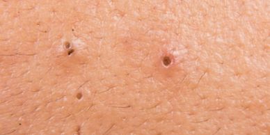 Blackheads on skin