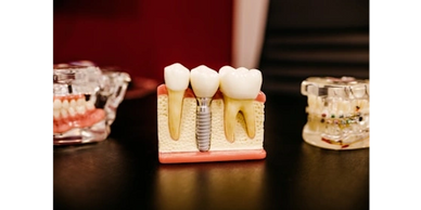 Implants and Implant Dentures