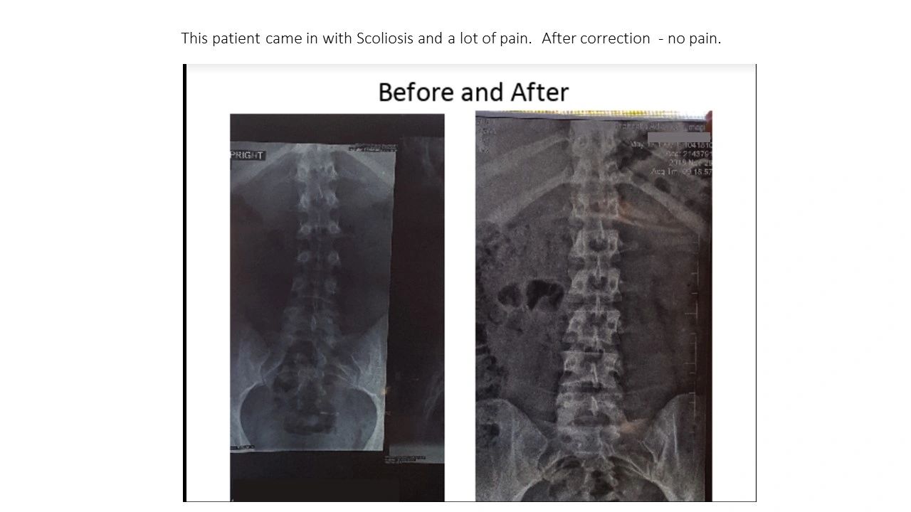 X-ray showing scoliosis correction from curved to straight spine.