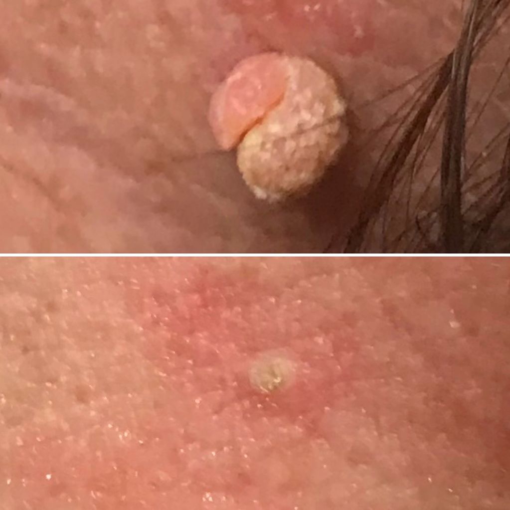 Skin tag removal before and after.