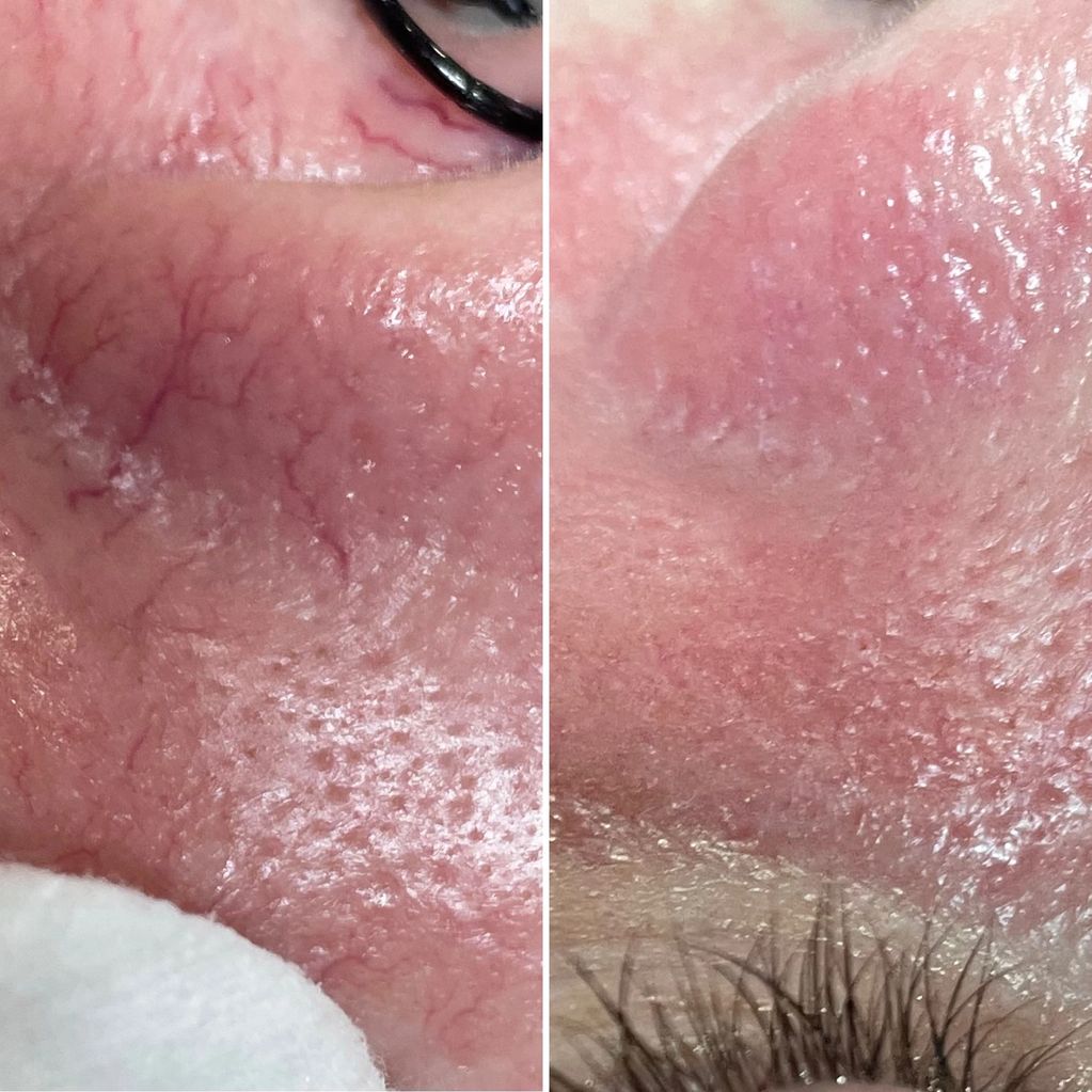 Thread veins on a nose.