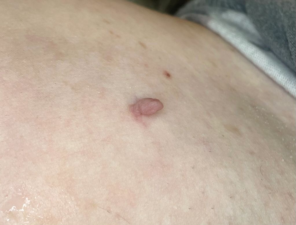 Skin tag.
