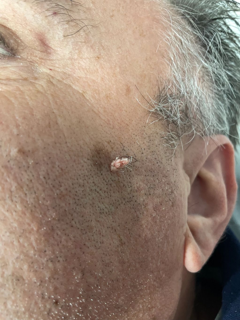 Filiform wart in the shave area.