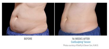 Coolsculpting Results at 16 weeks. Cooolsculpting Near Me. Hilton Head Coolsculpting