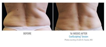 Hilton Head Coolsculpting Results. Bluffton Coolsculpting Results. Great Coolsculpting Near Me.