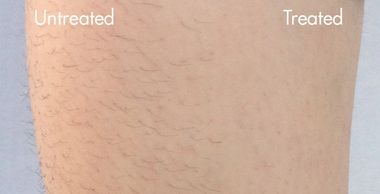 Diolaze, DiolazeXl, Diolaze Bluffton, Diolaze Hilton Head, Tracy Blusweicz, Katherine Coley