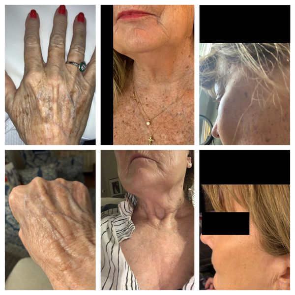 InMode Lumecca. Phenomenal results 10 days after treatment.