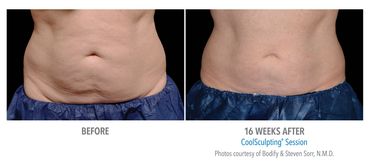 Coolsculpting Results. Hilton Head Coolsculpting Results, Great Coolsculpting results near me.